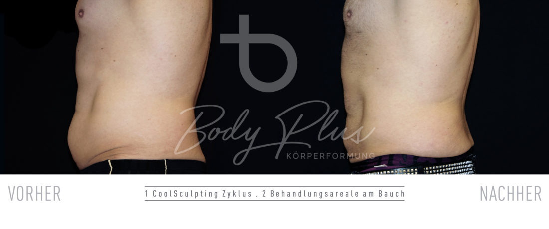 CoolSculpting Mann Bauch vorher-nachher fotos